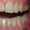 Отбеливание зубов. Восстановление, лечение, удаление - Изображение #6, Объявление #1335601