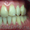 Отбеливание зубов. Восстановление, лечение, удаление - Изображение #2, Объявление #1335601