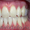 Отбеливание зубов. Восстановление, лечение, удаление - Изображение #3, Объявление #1335601