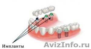 Имплант-центр доктора Ерохина. Зубная имплантация по приемлемым ценам. - Изображение #1, Объявление #701165
