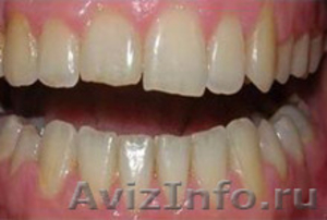 Отбеливание зубов. Восстановление, лечение, удаление - Изображение #6, Объявление #1335601