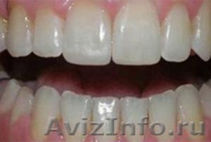 Отбеливание зубов. Восстановление, лечение, удаление - Изображение #7, Объявление #1335601