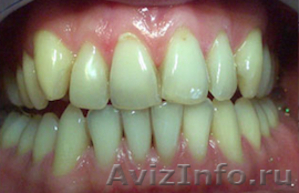 Отбеливание зубов. Восстановление, лечение, удаление - Изображение #2, Объявление #1335601