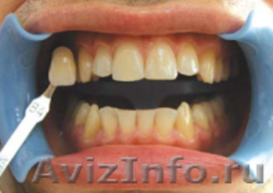 Отбеливание зубов. Восстановление, лечение, удаление - Изображение #4, Объявление #1335601