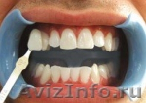 Отбеливание зубов. Восстановление, лечение, удаление - Изображение #5, Объявление #1335601