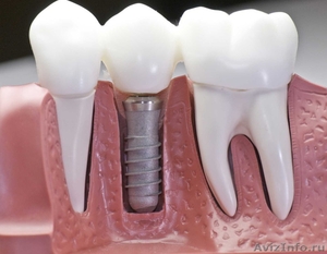 Имплантация и лечение зубов недорого - Изображение #1, Объявление #1518802