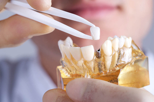 Denta Vi - протезирование зубов - Изображение #1, Объявление #1719984